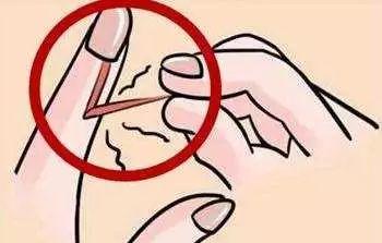 寶寶手指出現(xiàn)倒刺是怎么回事？需要補(bǔ)充維生素嗎？