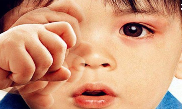 小孩頻繁揉眼，小心兒童過(guò)敏性結(jié)膜炎來(lái)襲