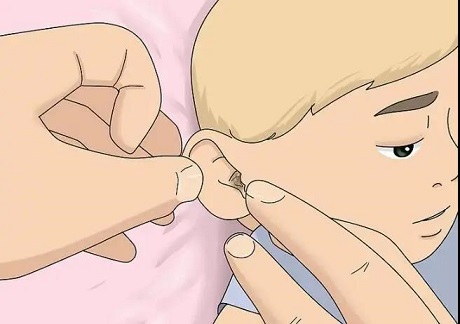 5歲女孩聽力下降，醫(yī)生檢查發(fā)現(xiàn)耳屎堵滿了耳道