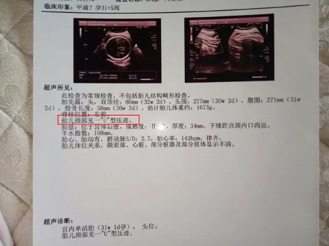 孕媽要注意了，你的這些習(xí)慣可能讓胎兒臍帶繞頸