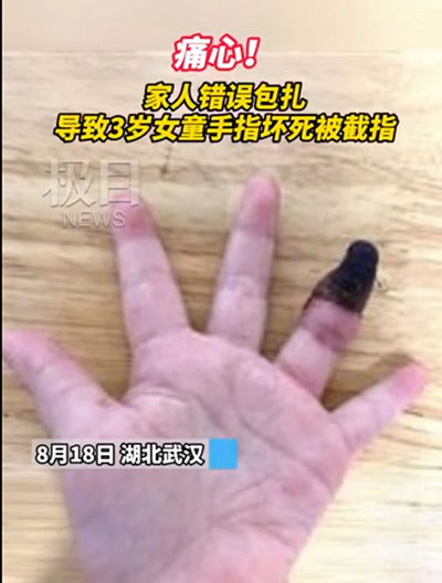 創(chuàng)可貼可別亂用，三歲女童因錯誤包扎手指壞死