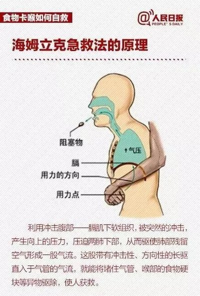 家長(zhǎng)必備技能----海姆立克急救法